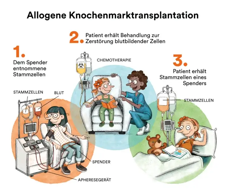 Illustration Knochenmarktransplantati on bei Blutkrebs