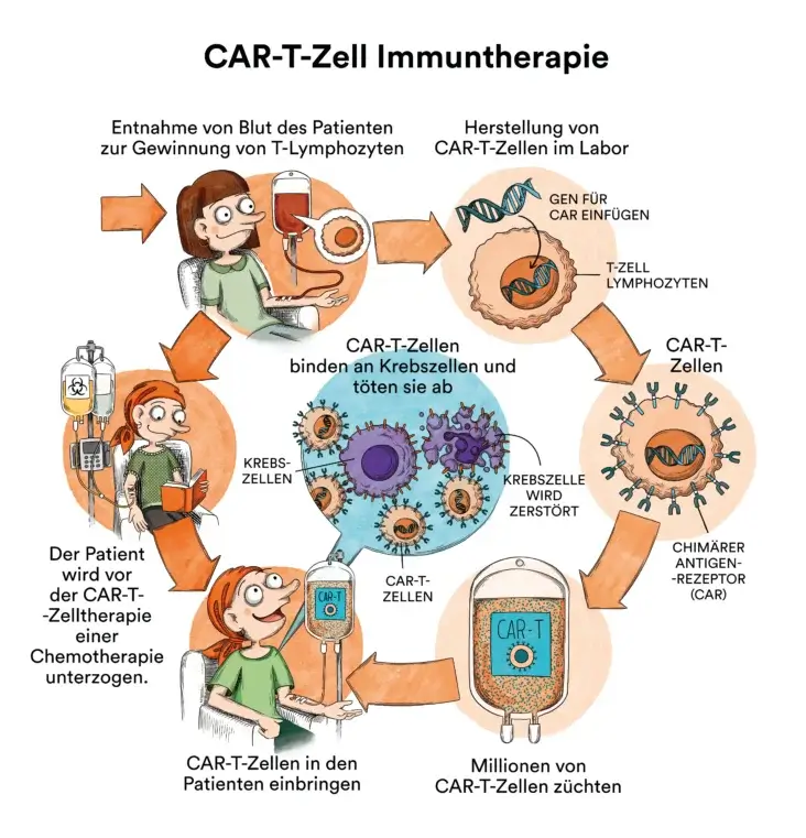 Illustratin CAR-T-Zell Therapie bei Blutkrebs